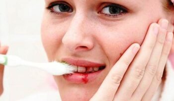 Gusi berdarah sering dianggap sepele. Padahal, penyakit gusi memiliki hubungan dengan peradangan dan sejumlah kondisi kronis seperti diabetes serta penyakit kardiovaskular.(istimewa)