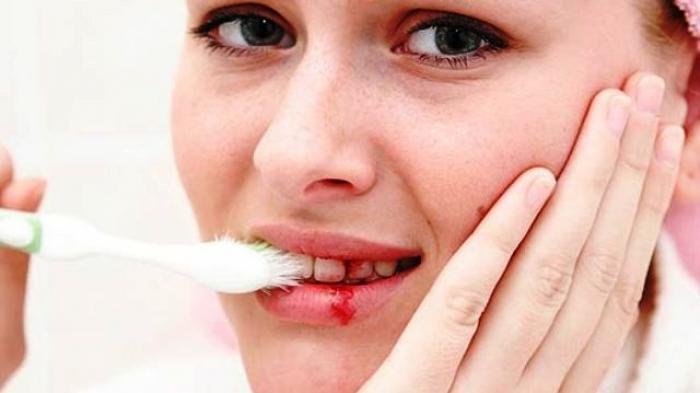 Gusi berdarah sering dianggap sepele. Padahal, penyakit gusi memiliki hubungan dengan peradangan dan sejumlah kondisi kronis seperti diabetes serta penyakit kardiovaskular.(istimewa)